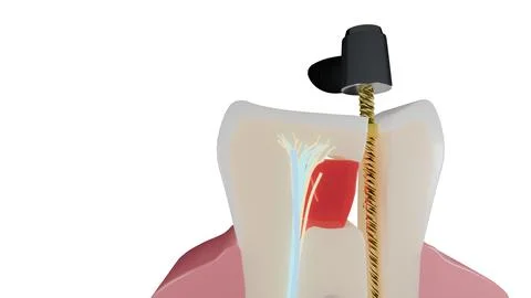 Macro view of molar cross section showing endodontic treatment on dark floor Stock Illustration