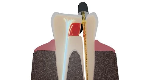Macro view of molar root canal treatment with rotary file and nerve fibers Stock Illustration
