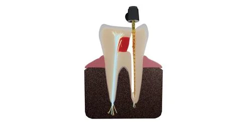 Macro view of molar tooth cross section with endodontic rotary file in root Stock Illustration