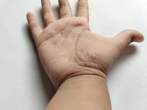 Macro view of small fluid-filled vesicles on a toddler's palm, illustrating symp Stockfoto's