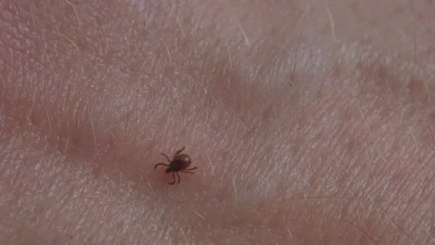 Macro view of tick crawling on human skin symbolizing infection risk 스톡 동영상 319519949