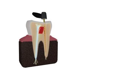 Macro view of tooth cross section with dental handpiece and endodontic file Stock Illustration