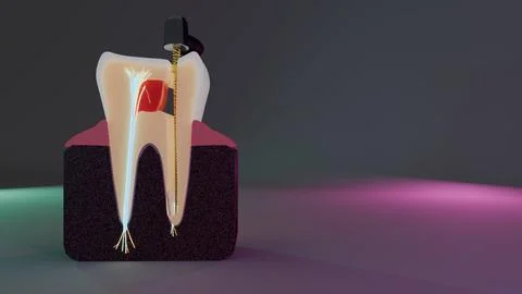 Macro view of tooth root canal procedure showing rotary instrument and Stock Illustration
