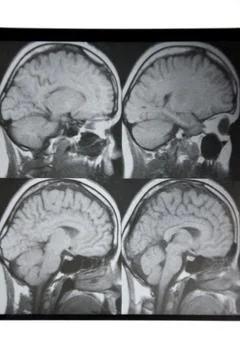 Macrophoto of computer tomography with the brain. Stock Photos