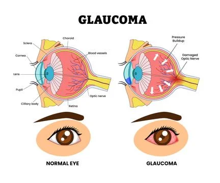 Macular Degeneration Eye Vision Problem, Eye Disease for Educational Medica.. Illustrazione stock
