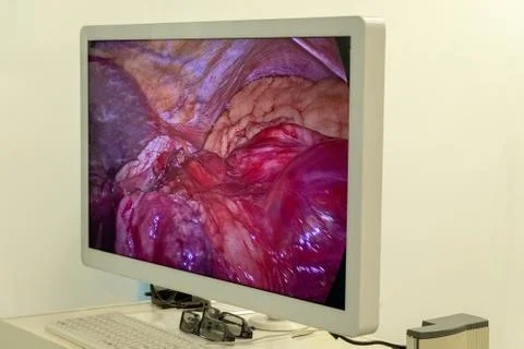 Mage of the operation process inside the patient's abdomen on the monitor or  Stock Photos