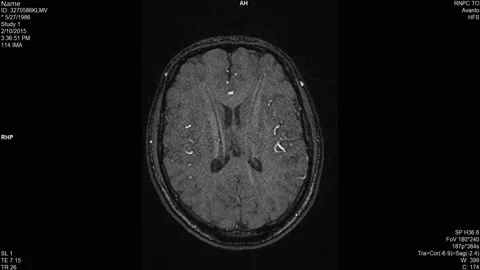 Magnetic resonance images of the brain (MRI brain) Vídeo Stock 171663104