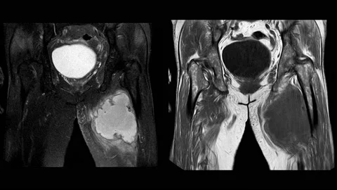 Magnetic Resonance Imaging (MRI) of both hip sagittal plane. Finding A large  Stock Footage 158902135