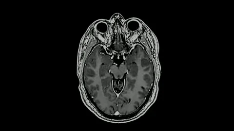 Magnetic resonance imaging MRI brain scan using magnetic field and radio waves Stock Footage 336561247