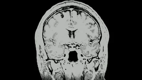 Magnetic resonance imaging MRI brain scan using magnetic field and radio waves Stock Footage 336561252