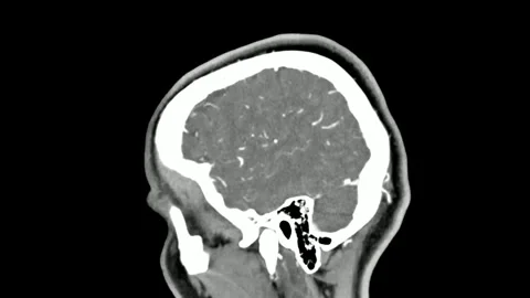 Magnetic resonance imaging MRI brain scan using magnetic field and radio waves Stock Footage 336561258