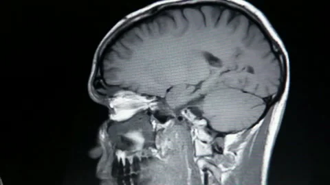 Magnetic resonance imaging MRI brain scan using magnetic field and radio waves Stock Footage 336561285