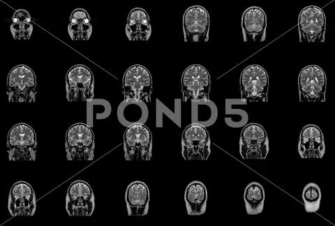 Magnetic resonance imaging MRI of brain stem Stock Illustration