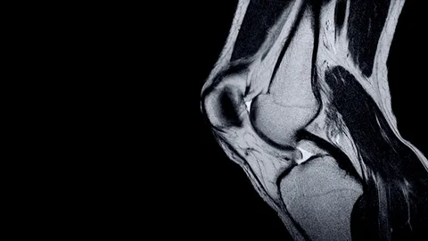 Magnetic resonance imaging (MRI) of right knee. Closed injury of the knee Stock Footage
