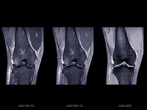 Magnetic resonance imaging or MRI of  knee joint Corona; T2 FS , PDW and Gr.. Stock Illustration