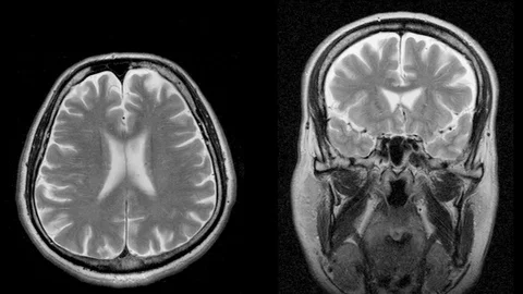 Magnetic resonance scan of the head top and front, MRI, looped Stock Footage 106322201