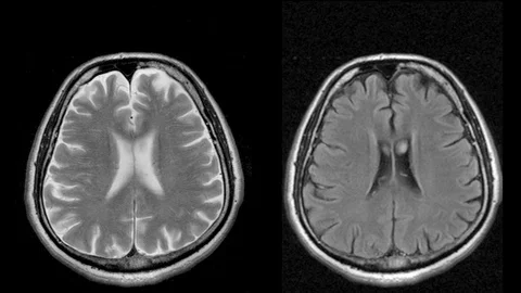 Magnetic resonance scan of the headache in two different ways, MRI, looped Stock Footage 106322198