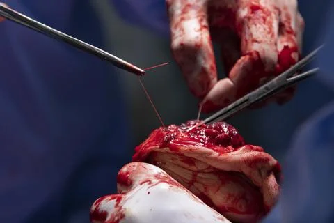 Making Stitches on a Hand Stump Stockfoto's
