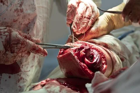 Making the Stump During the Amputation Foto stock