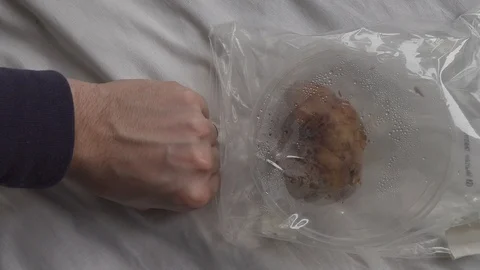 Male bladder stone Video stock 110946298