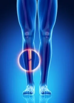Male bone anatomy tibia broken Illustrazione stock