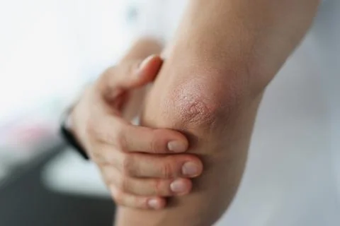 Male elbow and flaky skin and psoriasis Stock Photos