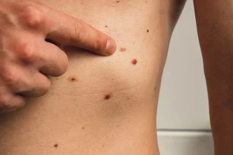 Male hand showing birthmarks on skin body stomach part. Close up detail of the Stock Photos