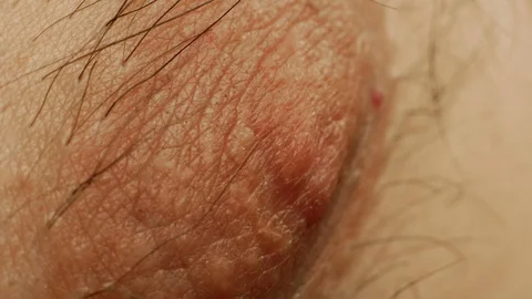 Male nipple close-up. The concept of plastic surgery on the male chest in men Stock Footage 129935053