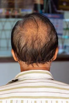 Male pattern baldness back of head view 写真素材