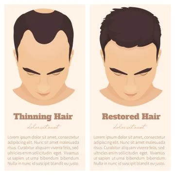 Male pattern baldness design template Stock Illustration