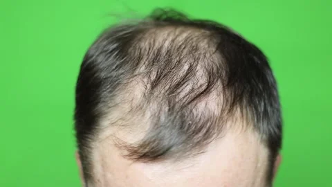 Male pattern baldness. head on a green screen. The problem of hair loss Video stock 143141890