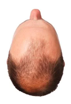 Male pattern baldness Stock Photos