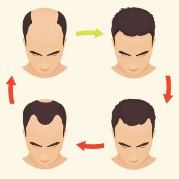 Male pattern baldness set Stock Illustration