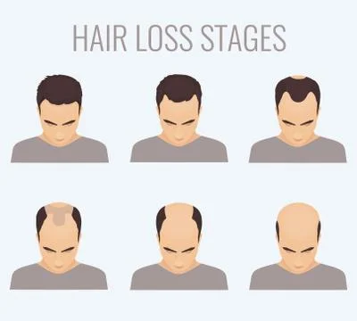 Male pattern baldness stages Stock Illustration