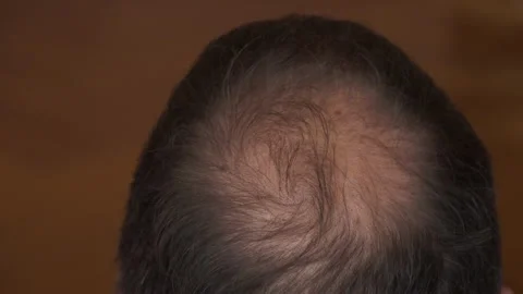 male pattern baldness, thinning crown | Stock Video | Pond5