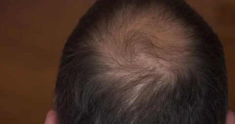 Male pattern baldness, thinning crown, hair loss 스톡 동영상 157373513