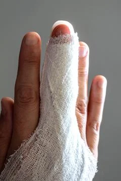 Mallet finger, stack splint on the middle finger with bandage to immobilize.. Stockfoto's