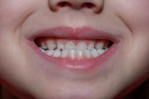 Malocclusion of a child, close-up on the front teeth of a child Stock Photos