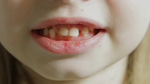 Malocclusion of large front teeth in young children Vídeo Stock 164604970