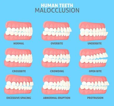 Malocclusion types side view dentist medical poster Stock Illustration