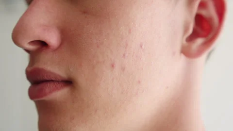 Mam with pimples on his face. Stock Footage 338173957