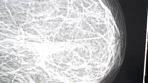 Mammogram used in diagnosis. Video stock 306397168