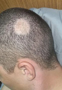 Man with 100-day-old patch of alopecia areta Stock Photos