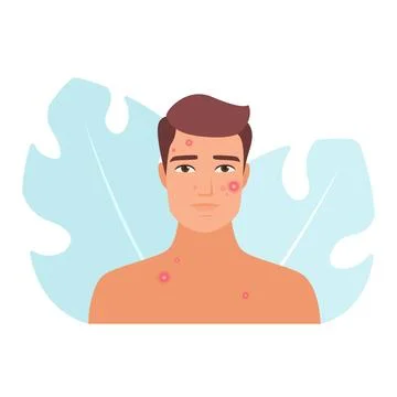 Man with acne and pimple problems Stock Illustration