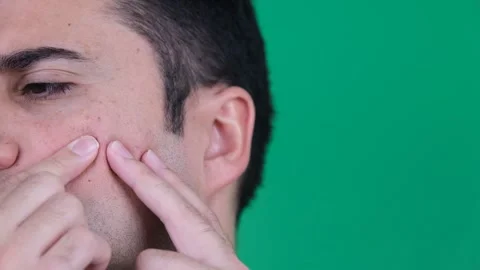 Man acne problem Video stock 288760051