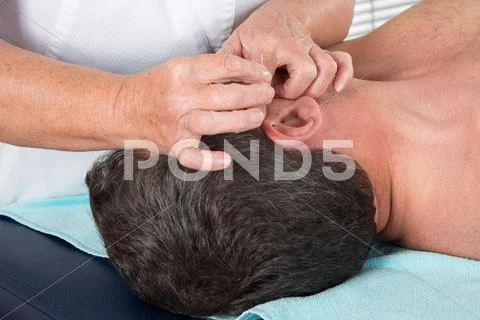 Man In An Acupuncture Therapy At The Health Spa