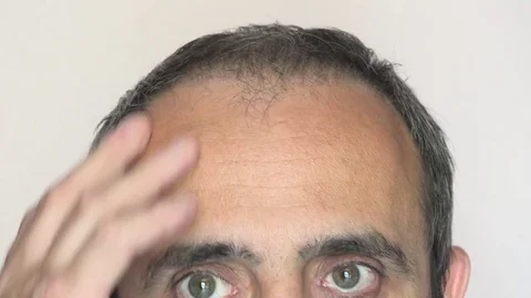 Man with alopecia problems Stock Footage 78642384