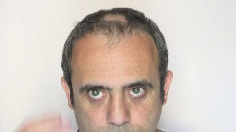 Man with alopecia problems Stock Footage 78642417