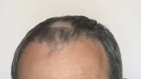 Man with alopecia problems Stock Footage 78642442