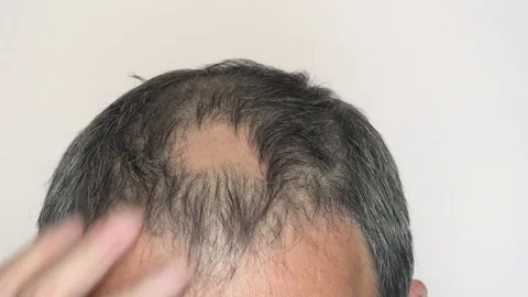 Man with alopecia problems Stock Footage 78642475